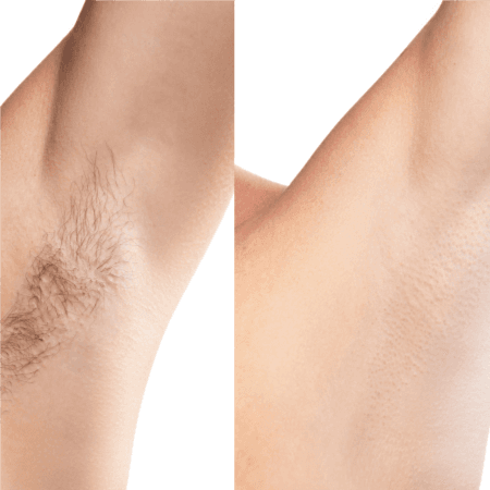 Underarm Package of 3 at Wellington Skin Studio in Wellington, FL